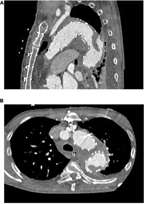 Postoperative In-Stent Thrombus Formation Following Frozen Elephant Trunk Total Arch Repair